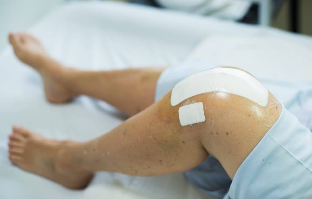 A Knee Replacement Recovery Timeline