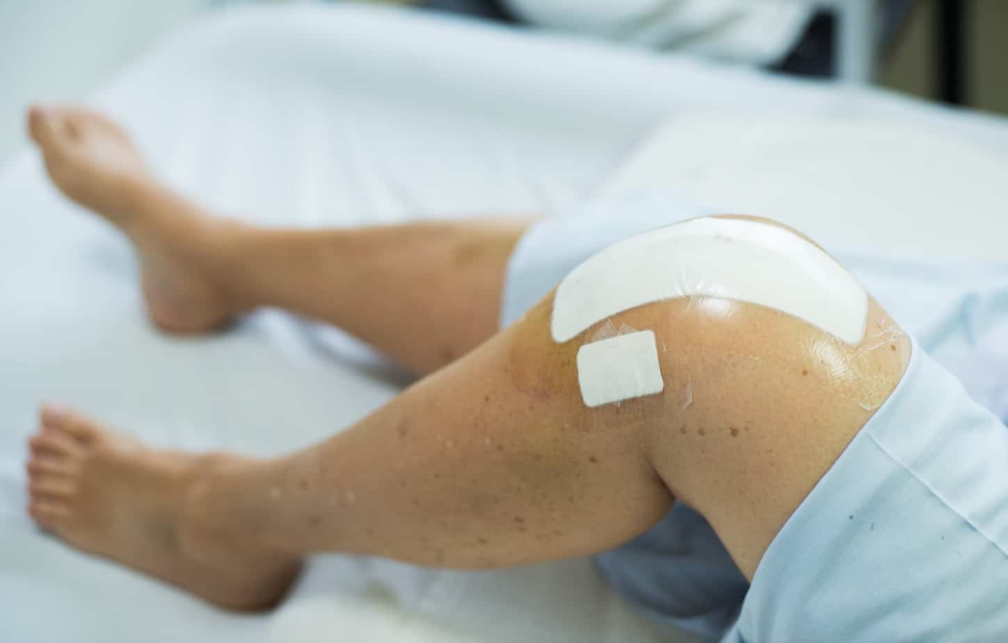 A Knee Replacement Recovery Timeline 