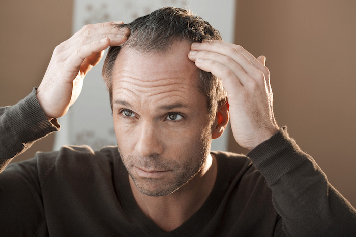 Suffering from Hair Loss? Scalp Micropigmentation Los ...